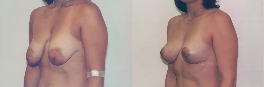 Real patient results in Newport Beach, CA Performed by Boris M. Ackerman MD