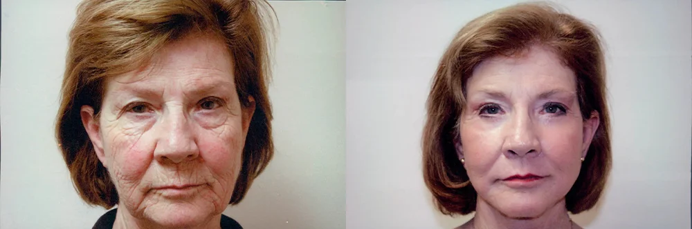 Real patient results in Newport Beach, CA Performed by Boris M. Ackerman MD