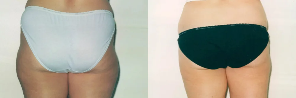 Real patient results in Newport Beach, CA Performed by Boris M. Ackerman MD