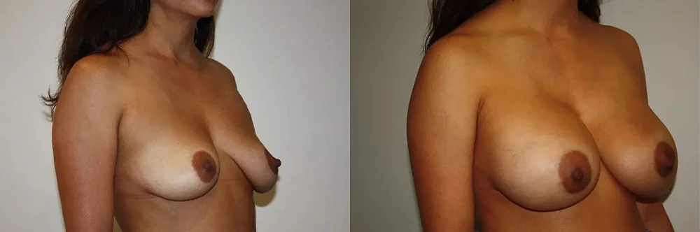 Real patient results in Newport Beach, CA Performed by Boris M. Ackerman MD
