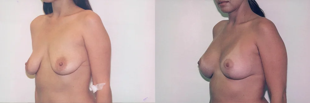 Real patient results in Newport Beach, CA Performed by Boris M. Ackerman MD