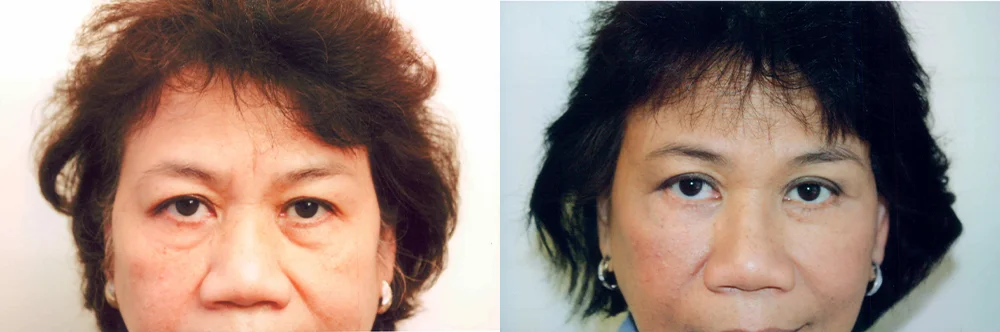 Real patient results in Newport Beach, CA Performed by Boris M. Ackerman MD