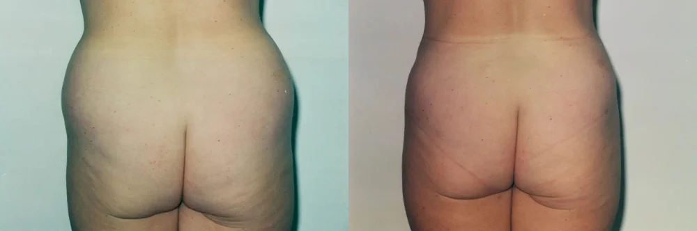 Real patient results in Newport Beach, CA Performed by Boris M. Ackerman MD