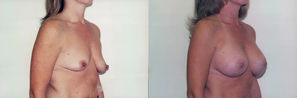 Real patient results in Newport Beach, CA Performed by Boris M. Ackerman MD