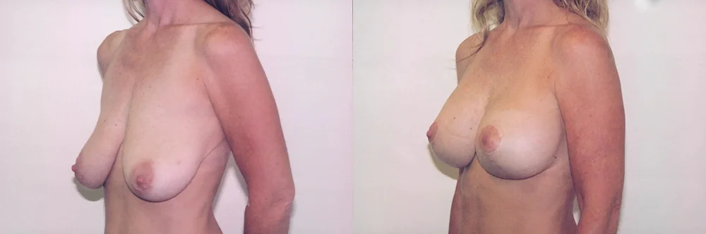 Real patient results in Newport Beach, CA Performed by Boris M. Ackerman MD