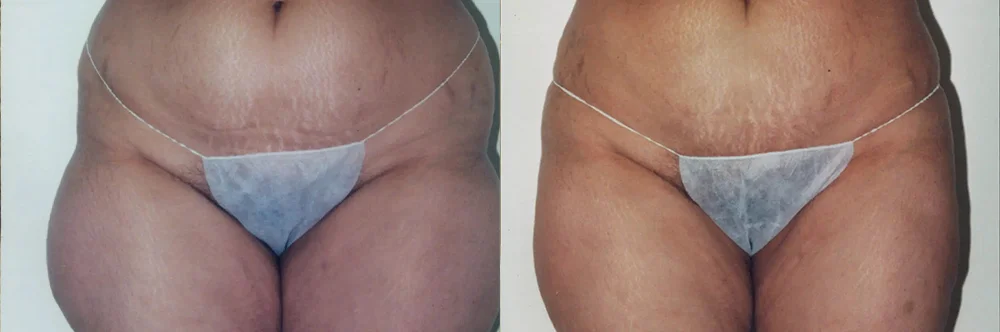 Real patient results in Newport Beach, CA Performed by Boris M. Ackerman MD
