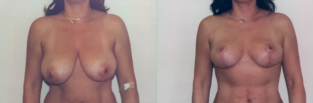 Real patient results in Newport Beach, CA Performed by Boris M. Ackerman MD