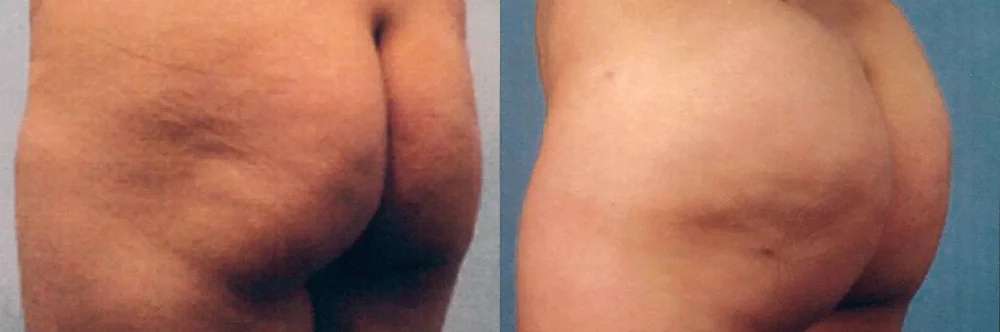 Real patient results in Newport Beach, CA Performed by Boris M. Ackerman MD