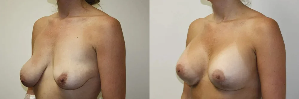 Real patient results in Newport Beach, CA Performed by Boris M. Ackerman MD