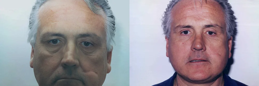 Real patient results in Newport Beach, CA Performed by Boris M. Ackerman MD