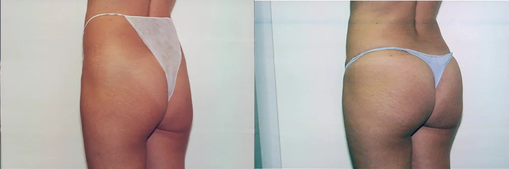 Real patient results in Newport Beach, CA Performed by Boris M. Ackerman MD