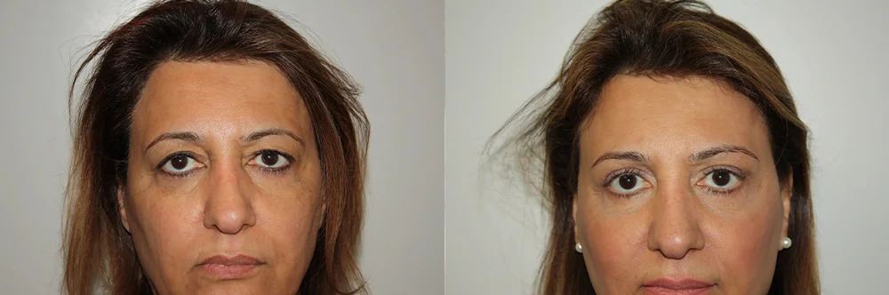 Real patient results in Newport Beach, CA Performed by Boris M. Ackerman MD