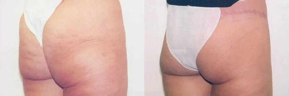 Real patient results in Newport Beach, CA Performed by Boris M. Ackerman MD