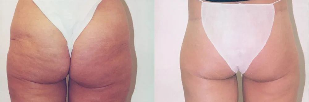 Real patient results in Newport Beach, CA Performed by Boris M. Ackerman MD