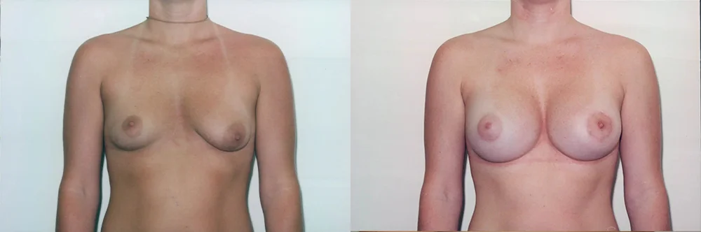 Real patient results in Newport Beach, CA Performed by Boris M. Ackerman MD
