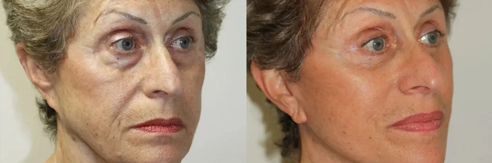 Real patient results in Newport Beach, CA Performed by Boris M. Ackerman MD