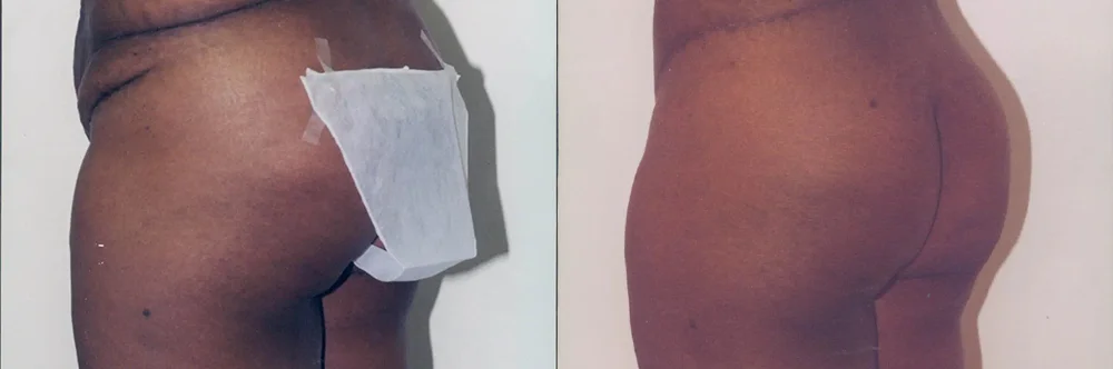 Real patient results in Newport Beach, CA Performed by Boris M. Ackerman MD