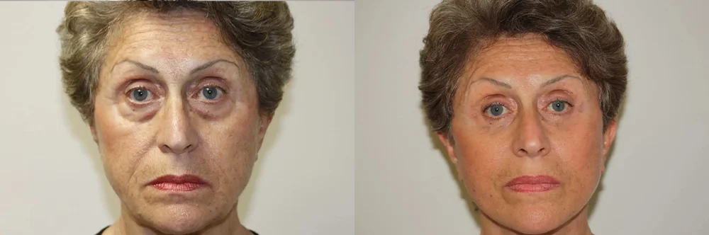 Real patient results in Newport Beach, CA Performed by Boris M. Ackerman MD