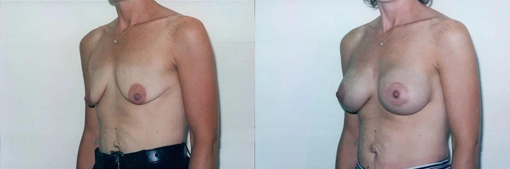 Real patient results in Newport Beach, CA Performed by Boris M. Ackerman MD
