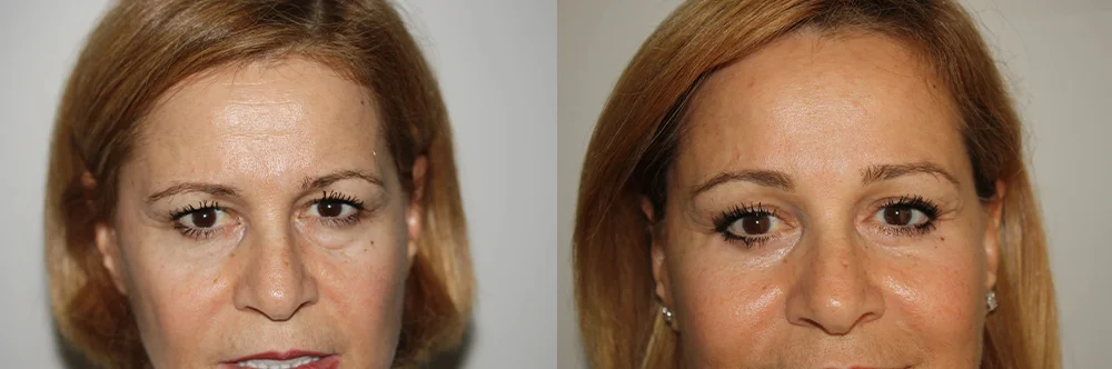 Real patient results in Newport Beach, CA Performed by Boris M. Ackerman MD
