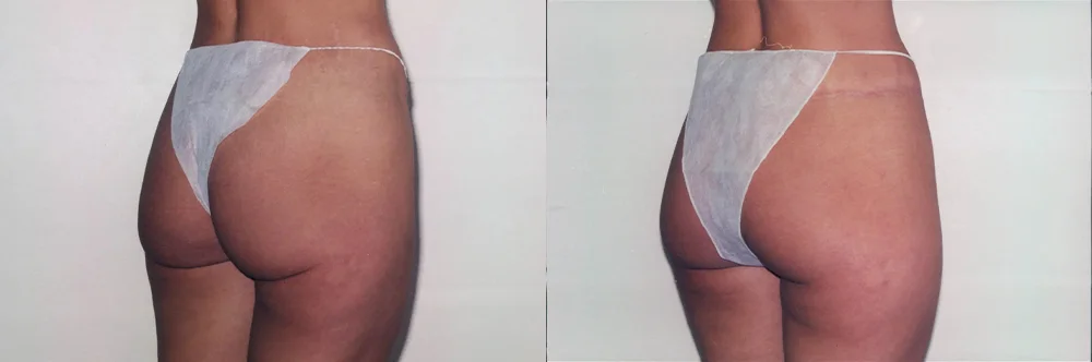 Real patient results in Newport Beach, CA Performed by Boris M. Ackerman MD