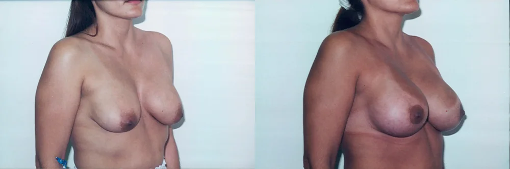 Real patient results in Newport Beach, CA Performed by Boris M. Ackerman MD