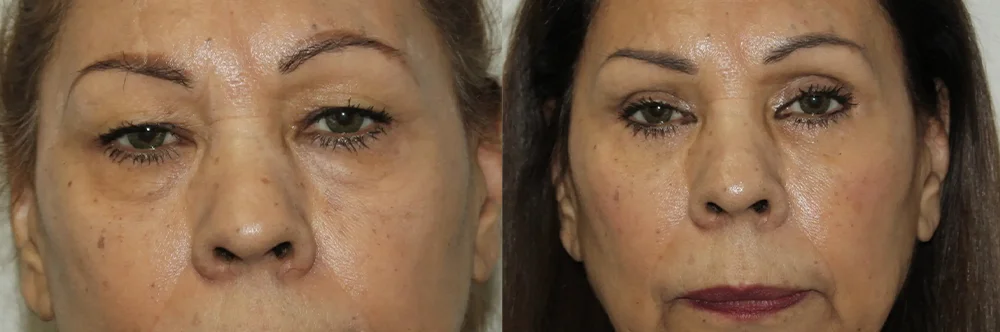 Real patient results in Newport Beach, CA Performed by Boris M. Ackerman MD