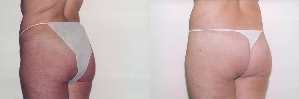 Real patient results in Newport Beach, CA Performed by Boris M. Ackerman MD