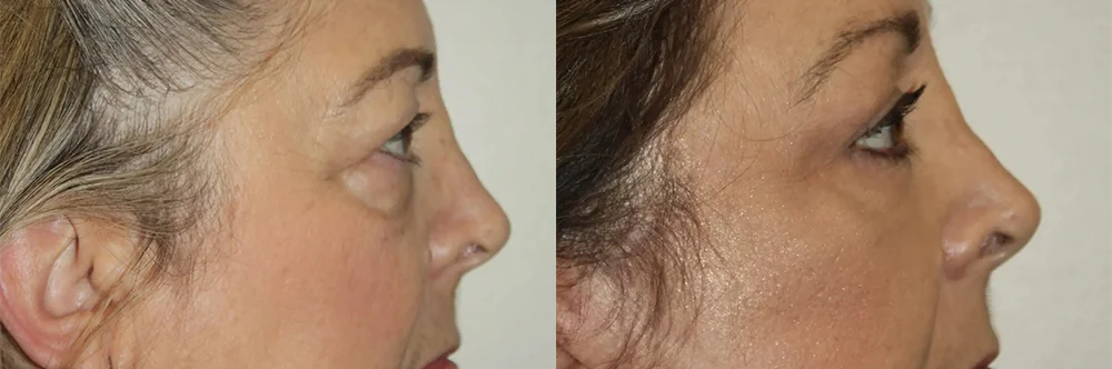 Real patient results in Newport Beach, CA Performed by Boris M. Ackerman MD
