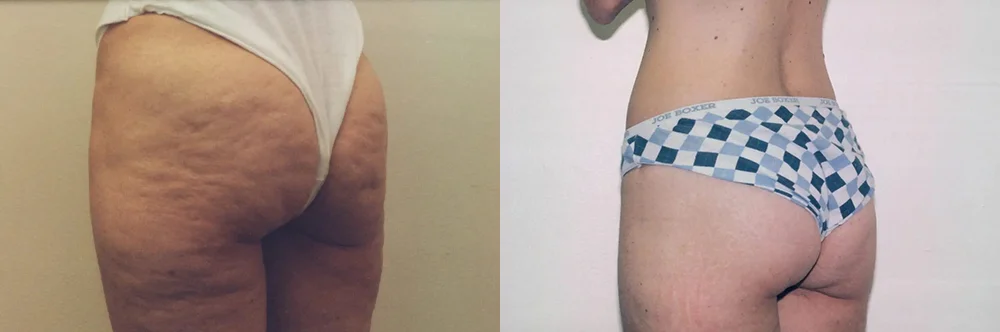 Real patient results in Newport Beach, CA Performed by Boris M. Ackerman MD