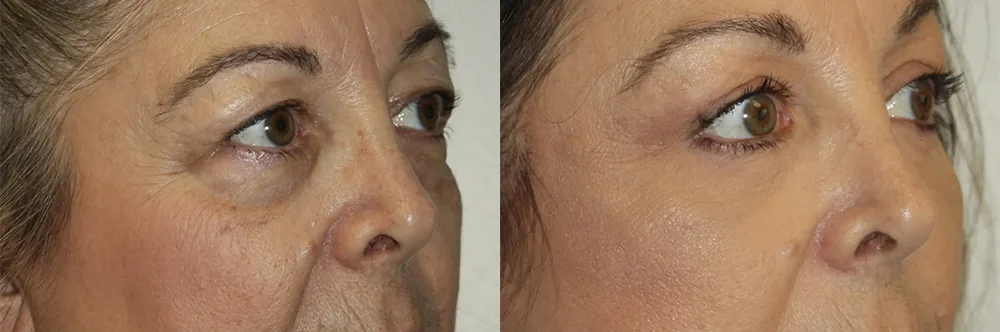 Real patient results in Newport Beach, CA Performed by Boris M. Ackerman MD