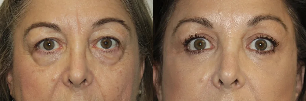 Real patient results in Newport Beach, CA Performed by Boris M. Ackerman MD