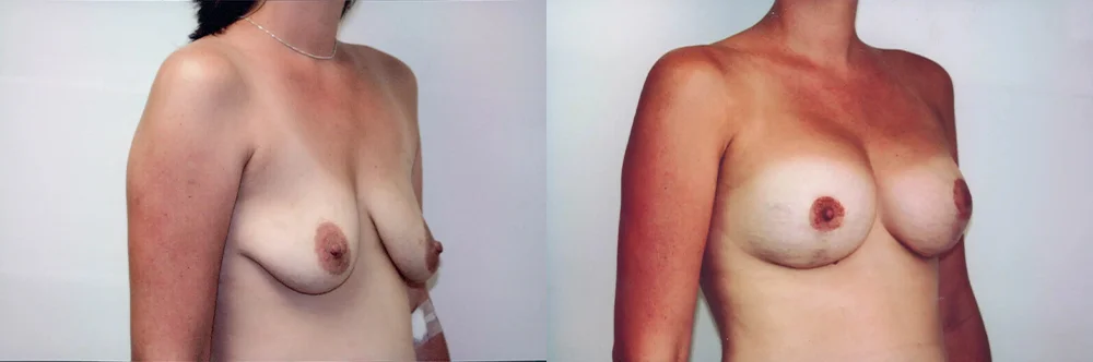Real patient results in Newport Beach, CA Performed by Boris M. Ackerman MD