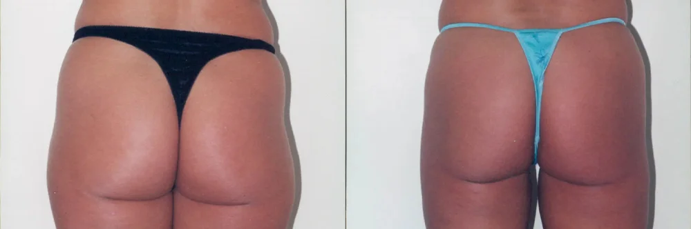 Real patient results in Newport Beach, CA Performed by Boris M. Ackerman MD