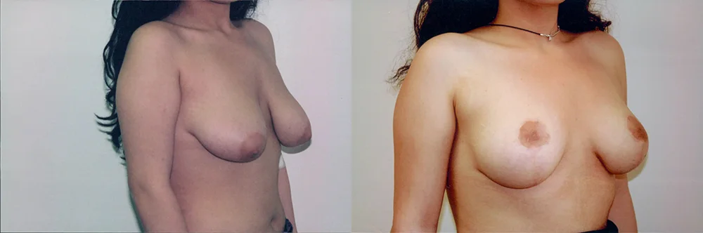 Real patient results in Newport Beach, CA Performed by Boris M. Ackerman MD