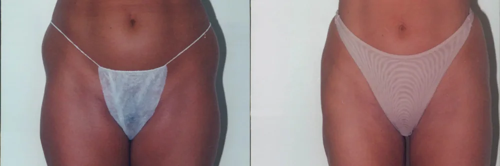 Real patient results in Newport Beach, CA Performed by Boris M. Ackerman MD