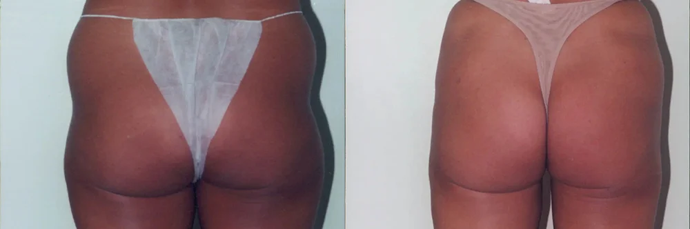 Real patient results in Newport Beach, CA Performed by Boris M. Ackerman MD
