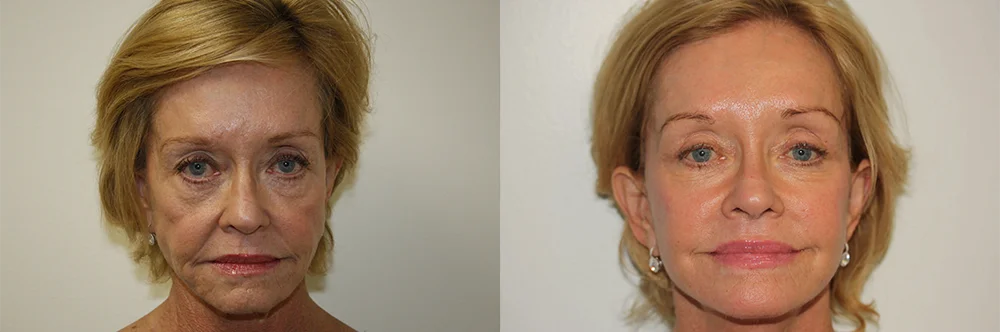 Real patient results in Newport Beach, CA Performed by Boris M. Ackerman MD