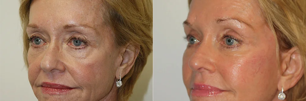 Real patient results in Newport Beach, CA Performed by Boris M. Ackerman MD