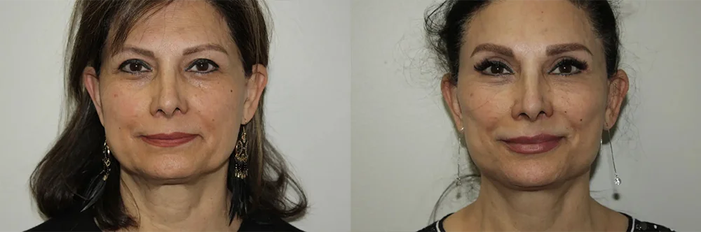 Real patient results in Newport Beach, CA Performed by Boris M. Ackerman MD
