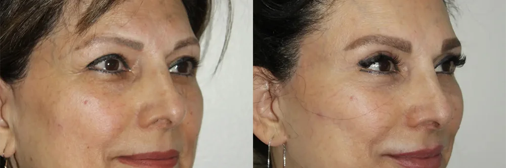 Real patient results in Newport Beach, CA Performed by Boris M. Ackerman MD