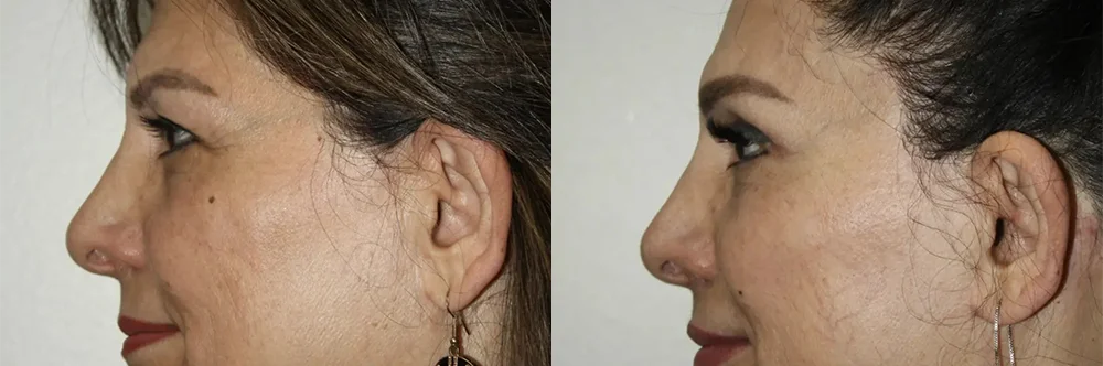 Real patient results in Newport Beach, CA Performed by Boris M. Ackerman MD