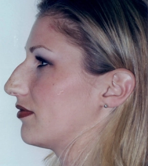 Real patient results in Newport Beach, CA Performed by Boris M. Ackerman MD