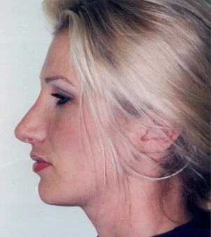 Real patient results in Newport Beach, CA Performed by Boris M. Ackerman MD