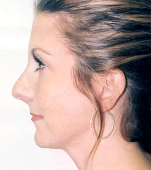 Real patient results in Newport Beach, CA Performed by Boris M. Ackerman MD