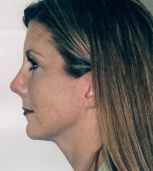 Real patient results in Newport Beach, CA Performed by Boris M. Ackerman MD