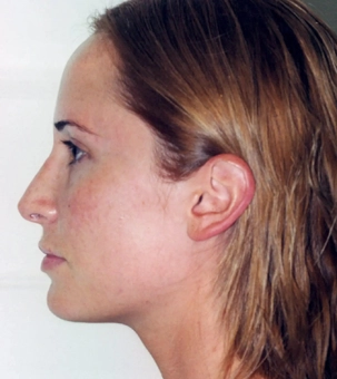 Real patient results in Newport Beach, CA Performed by Boris M. Ackerman MD