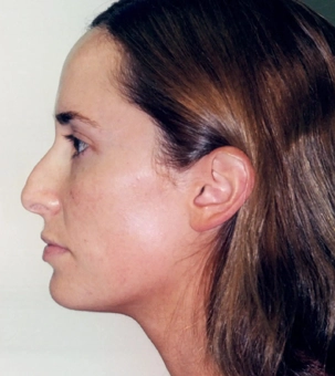 Real patient results in Newport Beach, CA Performed by Boris M. Ackerman MD