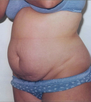 Real patient results in Newport Beach, CA Performed by Boris M. Ackerman MD