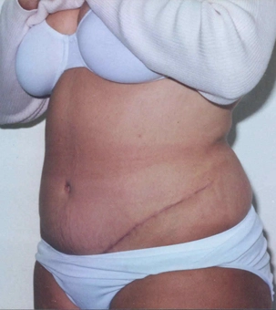 Real patient results in Newport Beach, CA Performed by Boris M. Ackerman MD